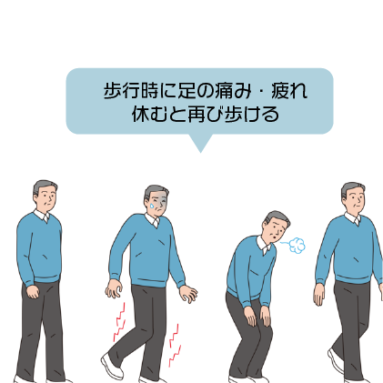 下肢閉塞性動脈硬化症の症状のイメージイラスト