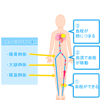 下肢静脈血栓症のイメージイラスト