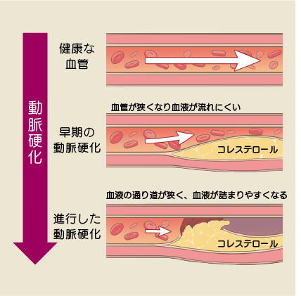 動脈硬化が進行して行くイメージイラスト