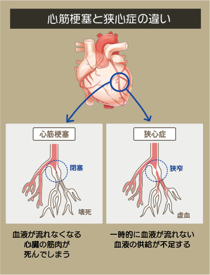 心筋梗塞と狭心症の違いを示した図